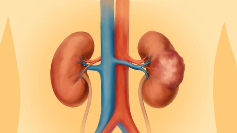Cáncer de riñón, síntomas que debe conocer